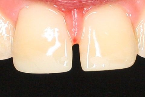 Início do polimento.