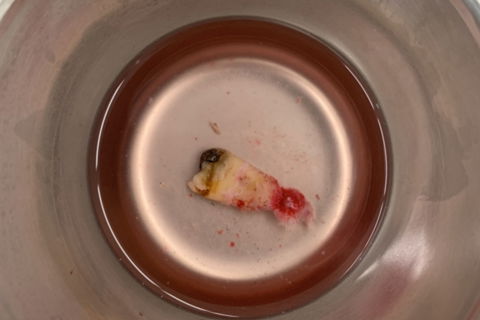 Lesão periapical de tecido mole.