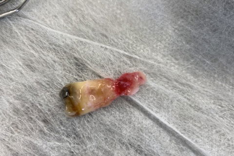 Lesão periapical de tecido mole.