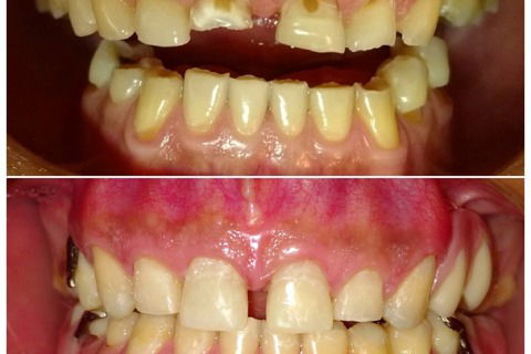 Antes e depois intra bucal.