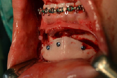 Fixação da mentoplastia com 3 parafusos de 16mm do sistema 2.0 