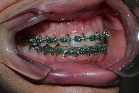 Oclusão pós operatório