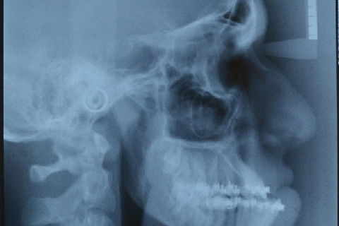 Telerradiografia de Perfil pré operatório