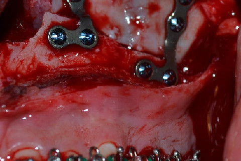 Fixação do avanço maxilar com placas de titânio do sistema 2.0