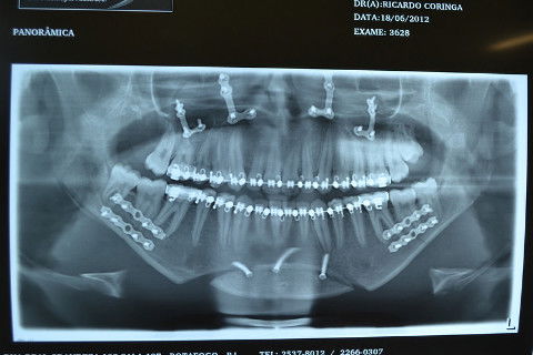 Radiografia Panorâmica pós operatória...