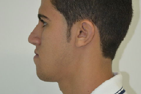 Perfil Esquerdo pré operatório