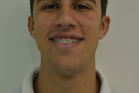 Frontal (sorriso) pré operatório