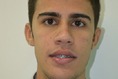 Vista frontal pós operatório de 2 meses