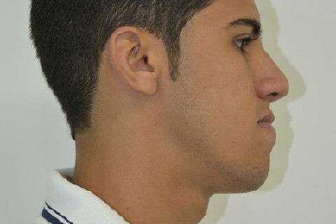 Perfil Direito pré operatório