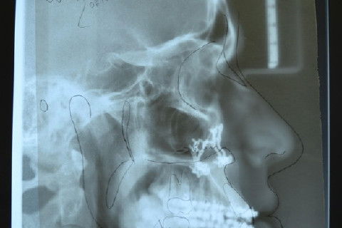 Telerradiografia de perfil pós-operatório sobreposto pelo traçado predictivo pré-operatório, nota-se boa correlação...