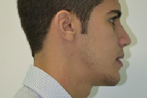 Perfil direito pós operatório de 2 meses