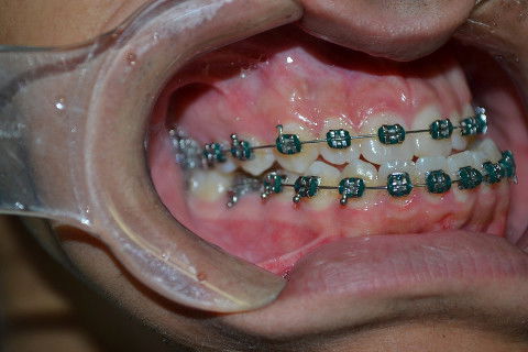 Oclusão (classe III) pré operatório