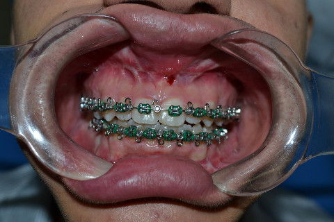 Oclusão pós operatório