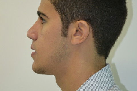 Perfil esquerdo pós operatório de 2 meses