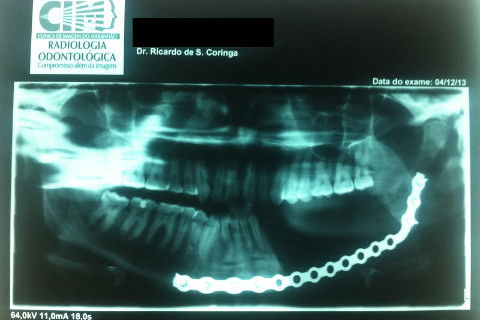 Rx Panorâmico após mandibulectomia parcial