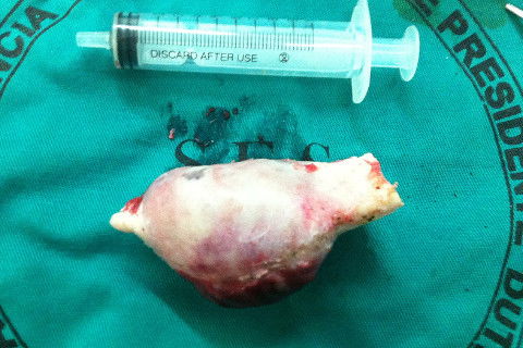 Lesão após ostectomia