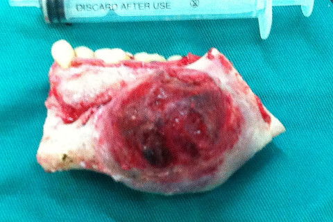 Lesão após ostectomia