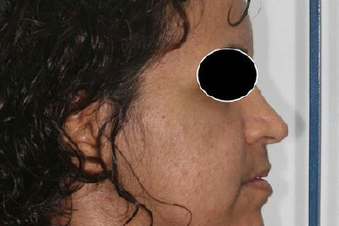 Controle pós-operatório de 2 meses