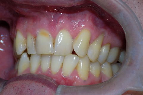 Facetas E.max em Anteriores