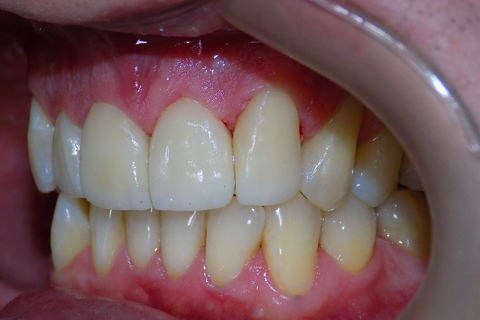 Facetas E.max em Anteriores