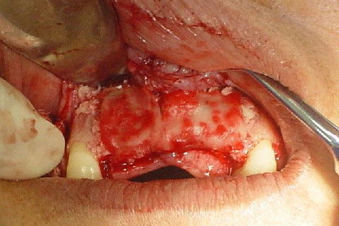 leito receptor com membrana embebida no soro fisiológico