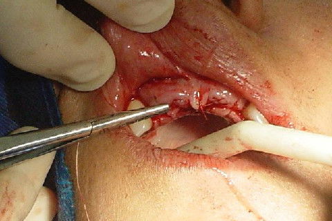 sutura do sitio receptor