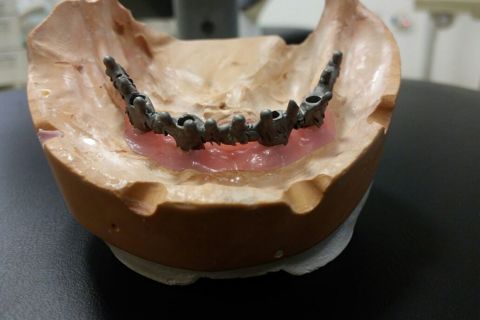 Reabilitação Estética e Funcional com Prótese Total Superior e Protocolo Inferior em Resina com 04 Implantes.