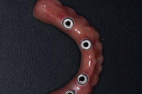 Protocolo em Resina com 4 Implantes.