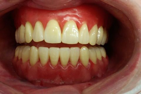 Reabilitação Estética e Funcional com Prótese Total Superior e Protocolo Inferior em Resina com 04 Implantes.