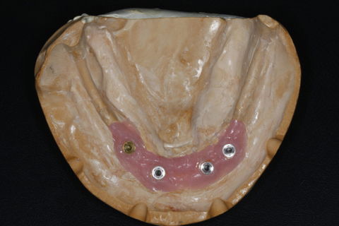 Reabilitação Estética e Funcional com Prótese Total Superior e Protocolo Inferior em Resina com 04 Implantes.