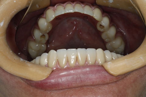 Reabilitação Estética e Funcional com Prótese Total Superior e Protocolo Inferior em Resina com 04 Implantes.