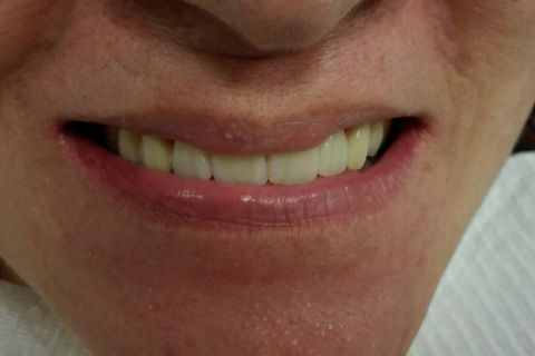 Reabilitação Estética e Funcional com Prótese Total Superior e Protocolo Inferior em Resina com 04 Implantes.