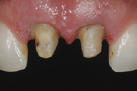 Preparos para coroa total