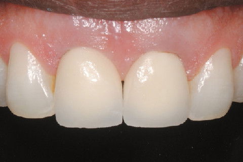 Detalhe após a cimentação