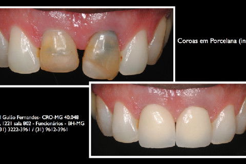 comparativo antes/depois