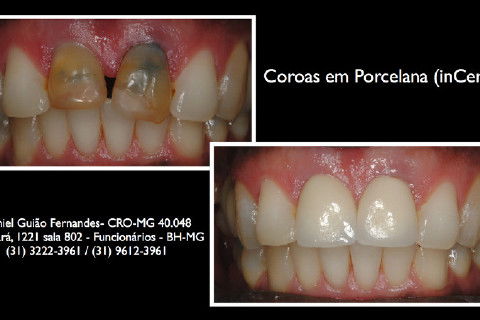 Comparativo antes/depois