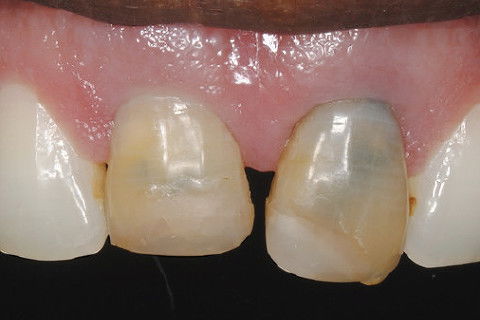 Detalhe dos elementos 11 e 21