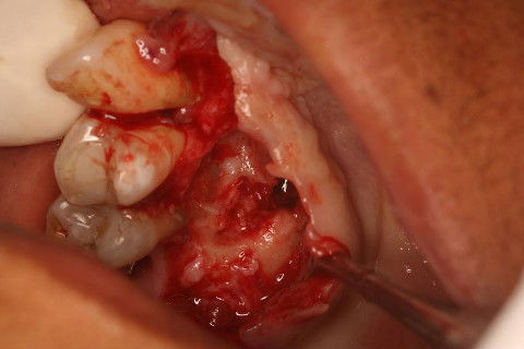 Loja Cirúrgica pós-extração