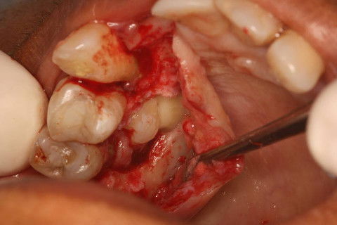 Osteotomia e Odontossecção(a coroa foi seccionada da raiz)