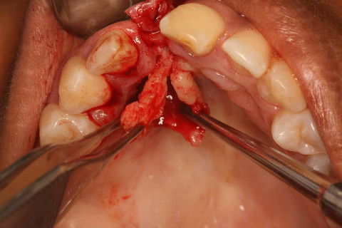Após divisão do retalho, o tecido conjuntivo separado para realização do enxerto.