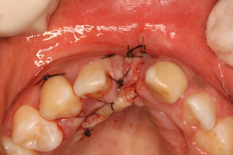 Perceptível melhor na espessura gengival.
