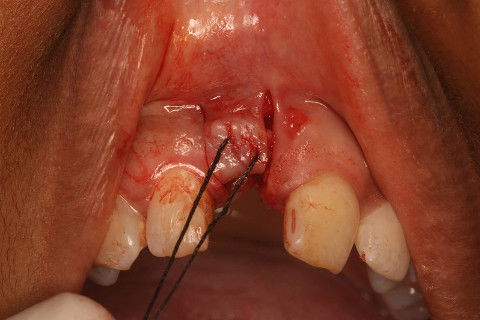 Após desepitelização da porção palatina do retalho, ele foi 