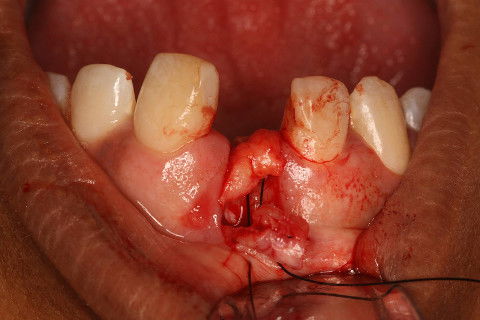 Sutura para posicionamento do enxerto conjuntivo no sítio receptor.