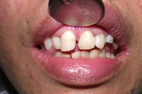 Obtendo o Máximo da Resina