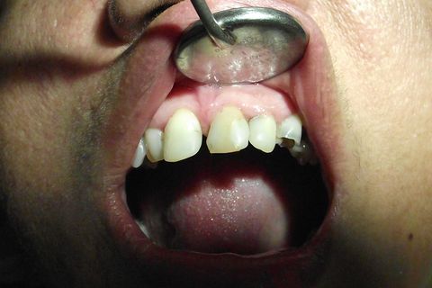 Obtendo o Máximo da Resina