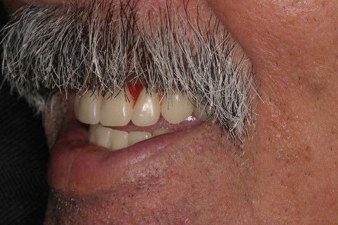 Prótese Total Dupla