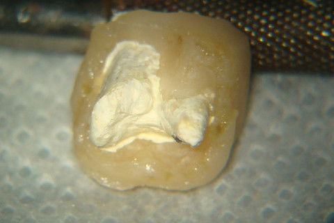 Retratamento de Canal, Tratamento de Perfuração, Restauração Provisória com Resina, Núcleo e Provisório.