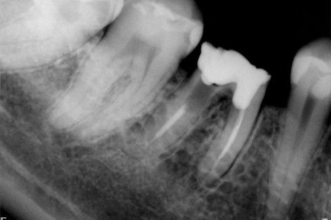 Retratamento de Canal, Tratamento de Perfuração, Restauração Provisória com Resina, Núcleo e Provisório.