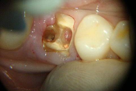 Retratamento de Canal, Tratamento de Perfuração, Restauração Provisória com Resina, Núcleo e Provisório.
