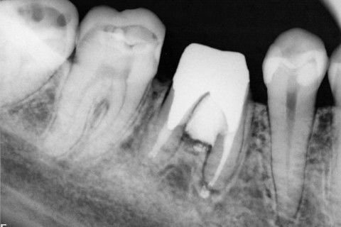 2º controle ( 4 meses após).